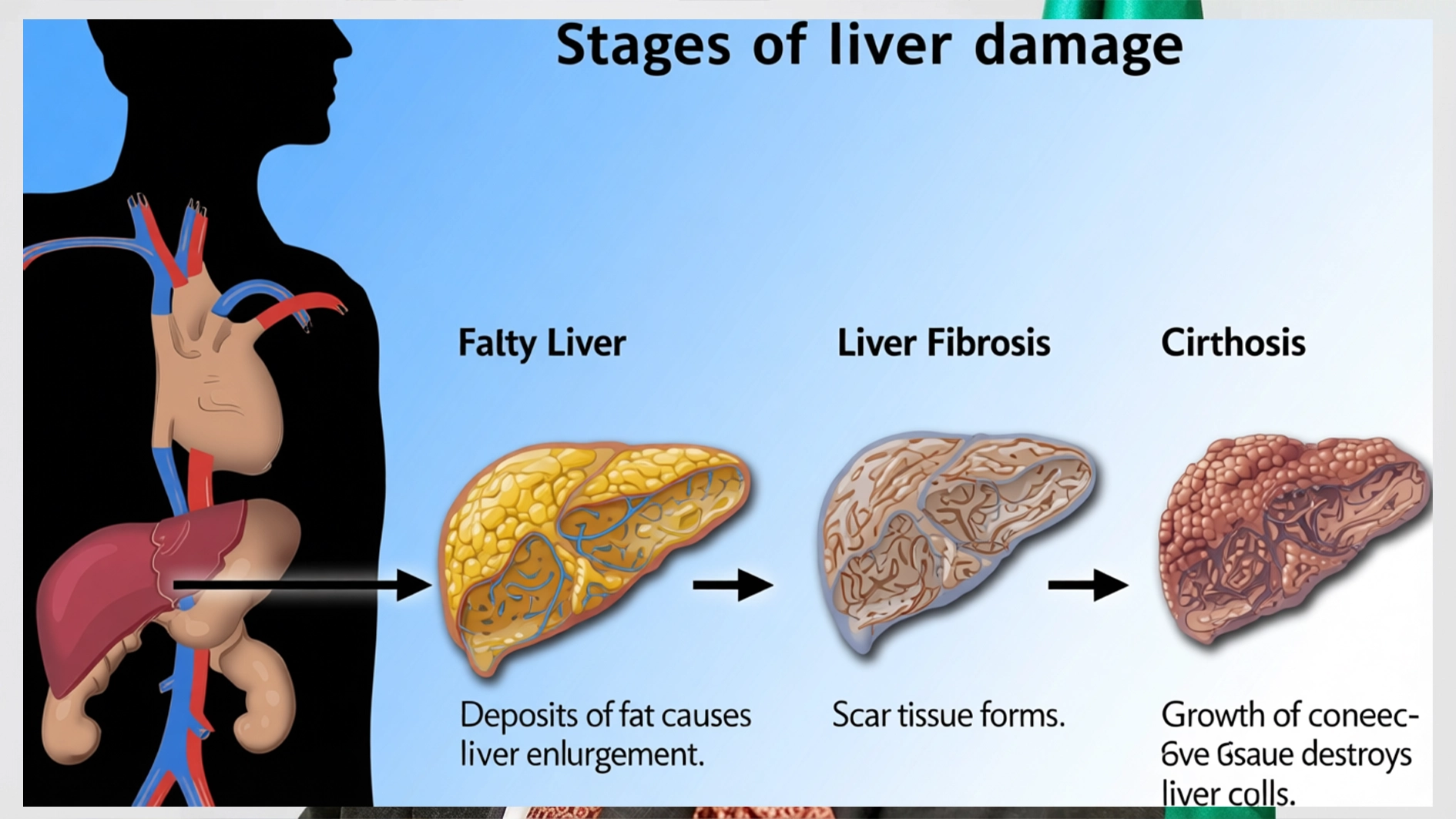 Fatty Liver Disease