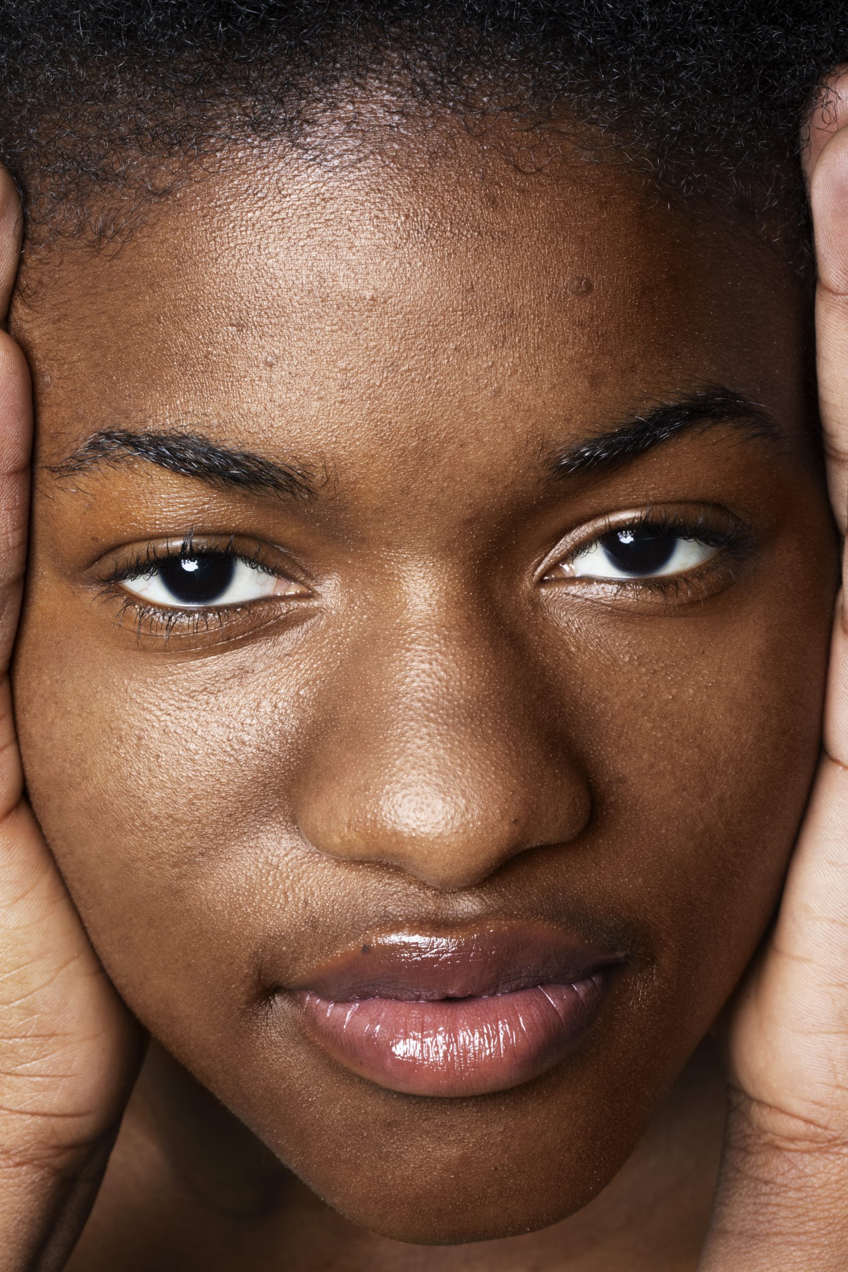 Main photo choice_ hyperpigmentation
