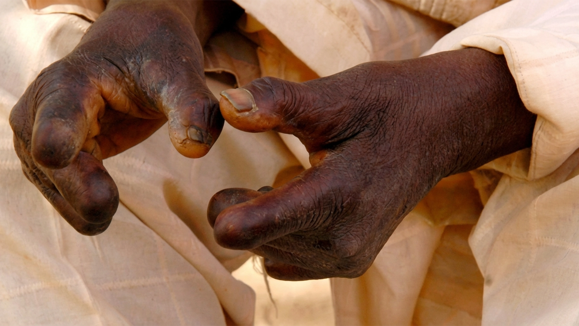 leprosy
