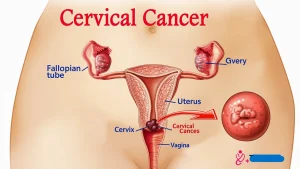 HPV infections