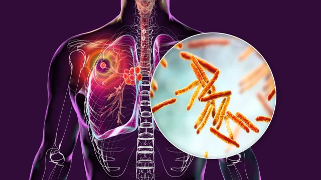 tuberculosis,