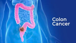 Colon cancer