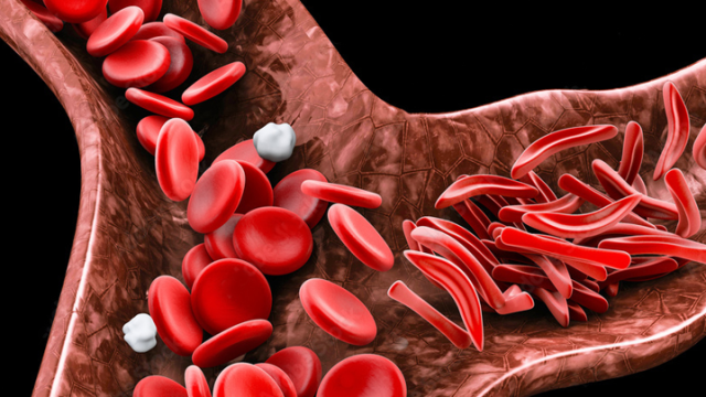 abc_sicklecell_scago