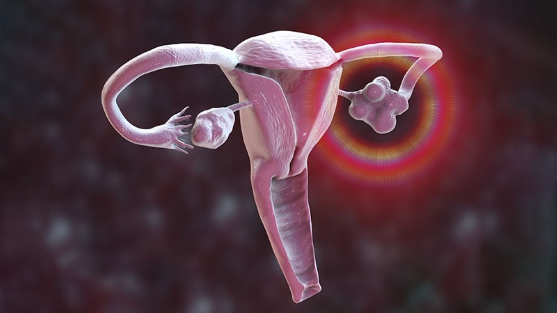 What-Is-Polycystic-Ovary-Syndrome_pv