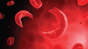 sickle+cells