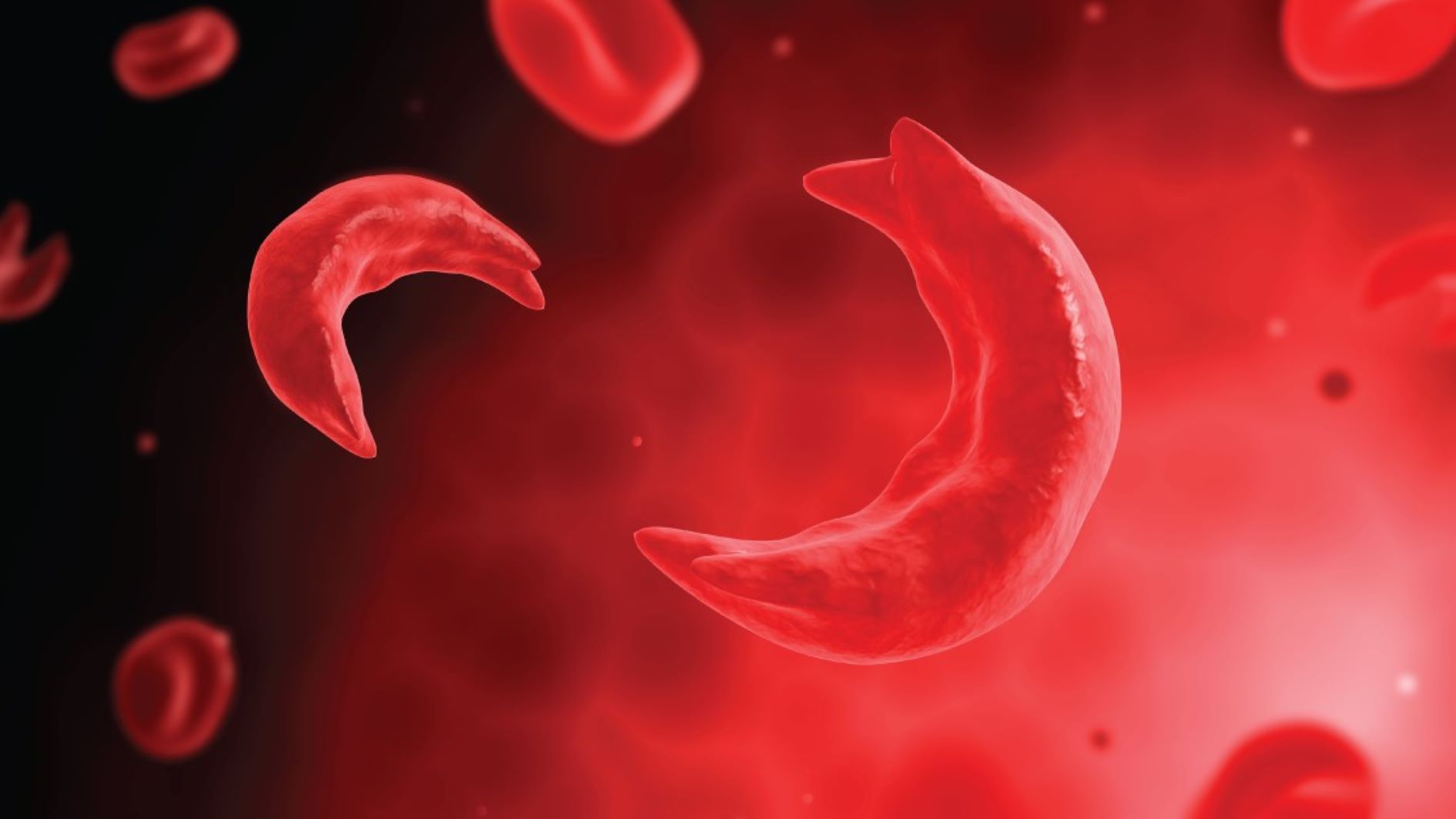 sickle+cells