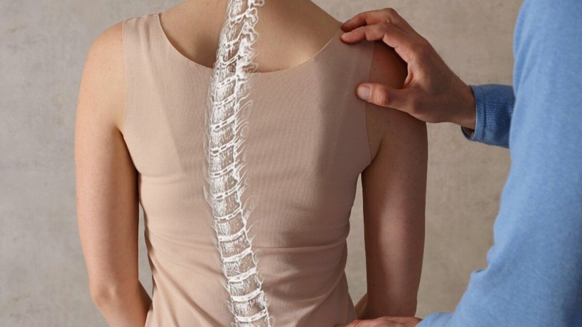 Scoliosis-1200×834
