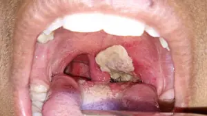 diphtheria