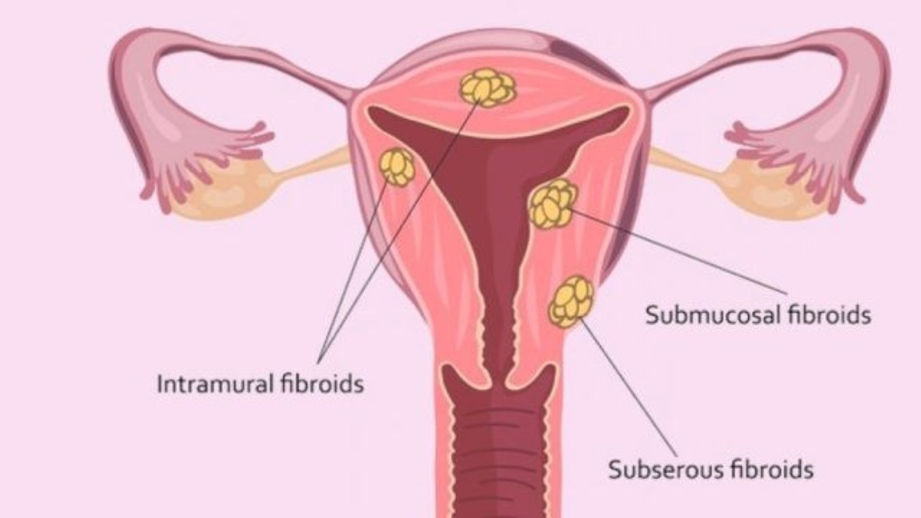 uterine-fibroid