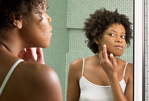 how-to-treat-acne-hypehair